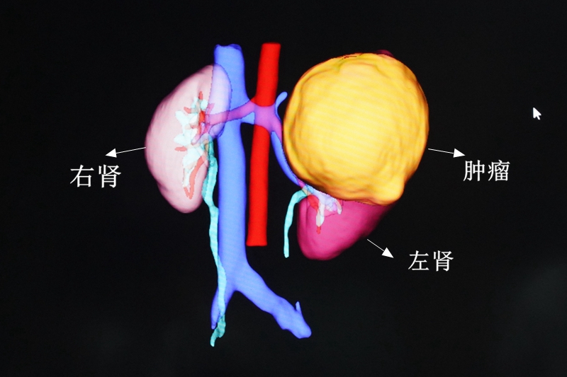 C:\Users\admin\Desktop\20230522泌尿外科10歲女童左腎長(zhǎng)巨大腫瘤，宛如第三個(gè)腎臟\DSC06254.JPG